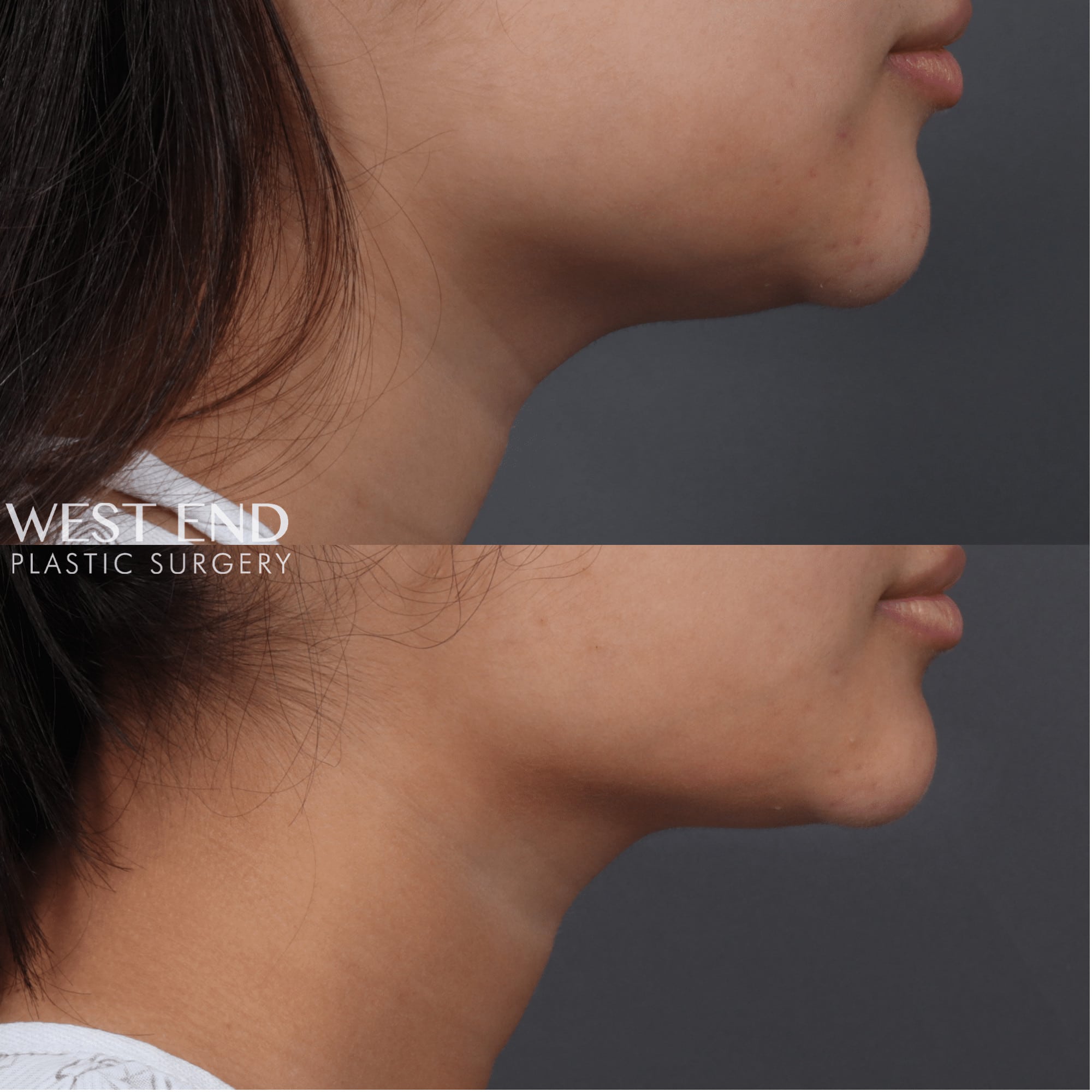 before after coolsculpting west end plastic surgery 1
