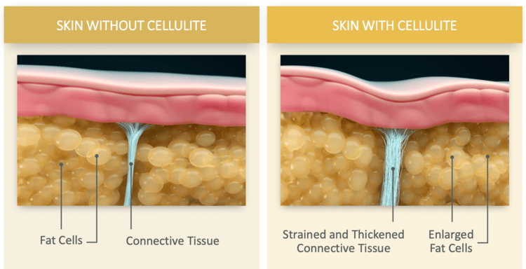 Cellulite 1