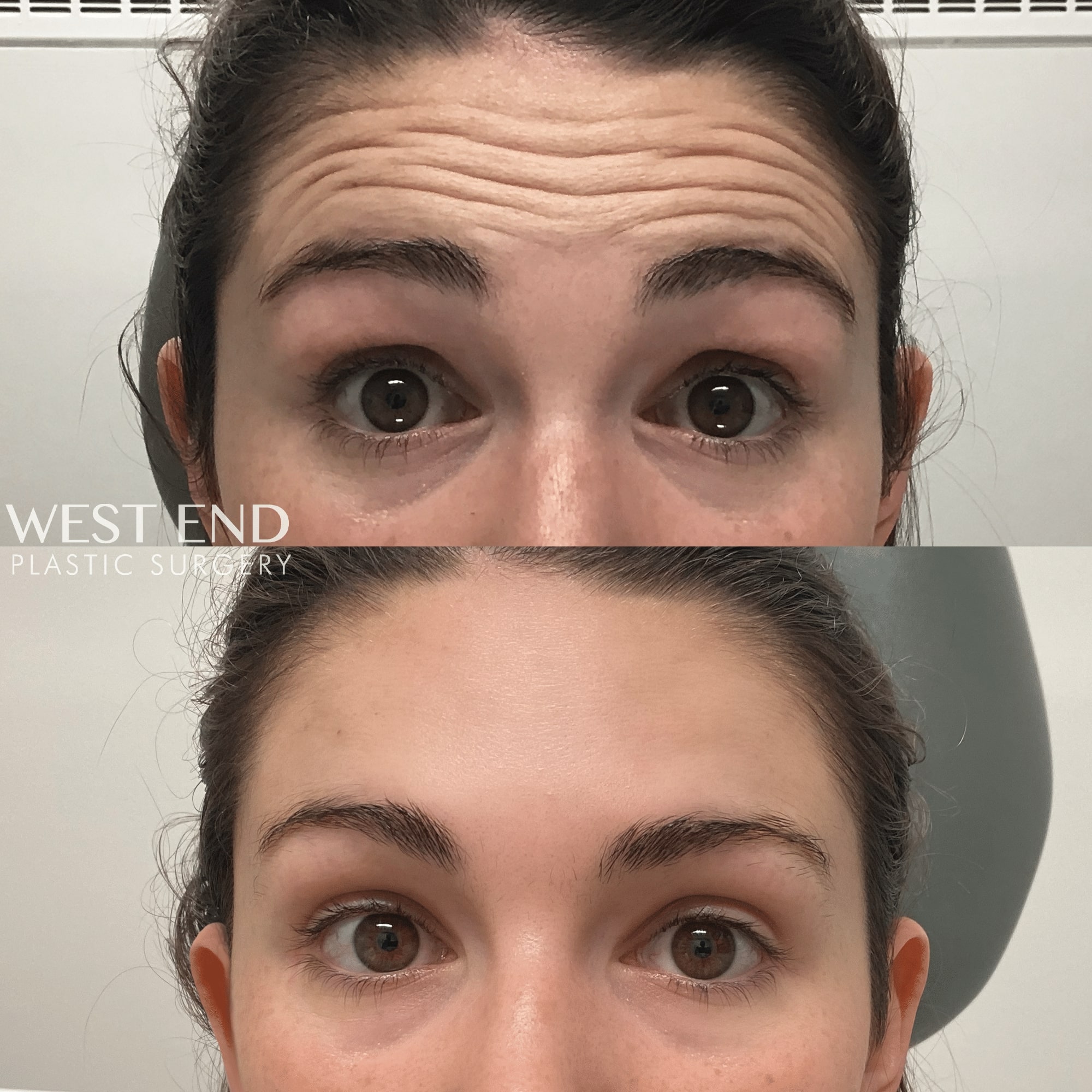 female patient’s forehead before and after dysport neuromodulator treatment, wrinkles gone afterwards