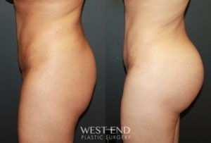 Brazilian Butt Lift in Washington, D.C. | West End Plastic Surgery 1