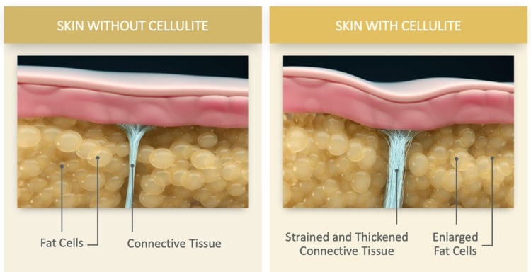 Cellulite 1