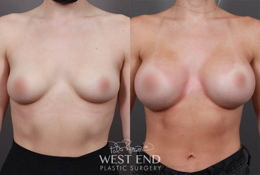 topless woman before and after breast augmentation with larger breasts after procedure