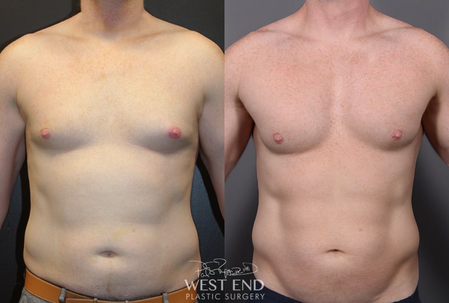 Body Implants Washington DC