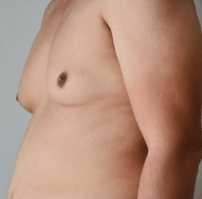 male breast reduction gynecomastia west end plastic surgery