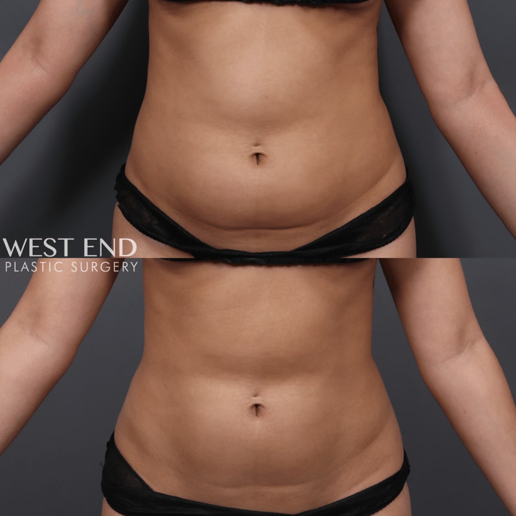 before after coolsculpting west end plastic surgery