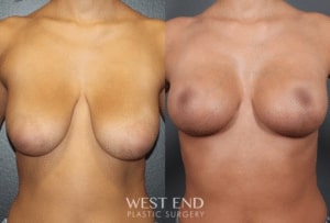breast lift before and after west end plastic surgery washington dc
