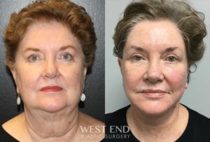 facelift surgery before and after west end plastic surgery exhibit e
