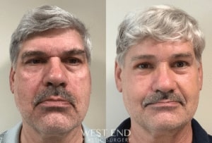 Brow Lift Surgeon Washington DC