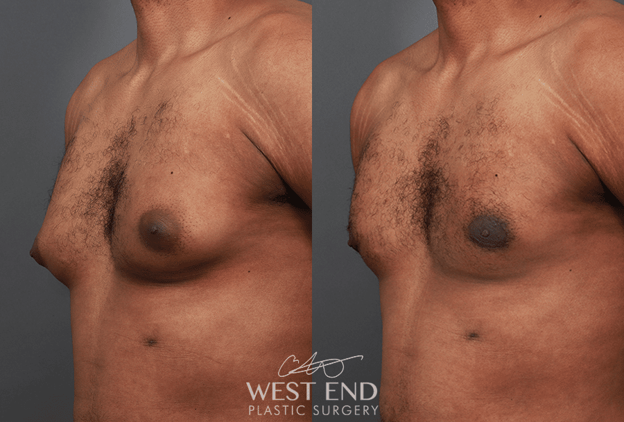 male breast reduction gynecomastia west end plastic surgery 1