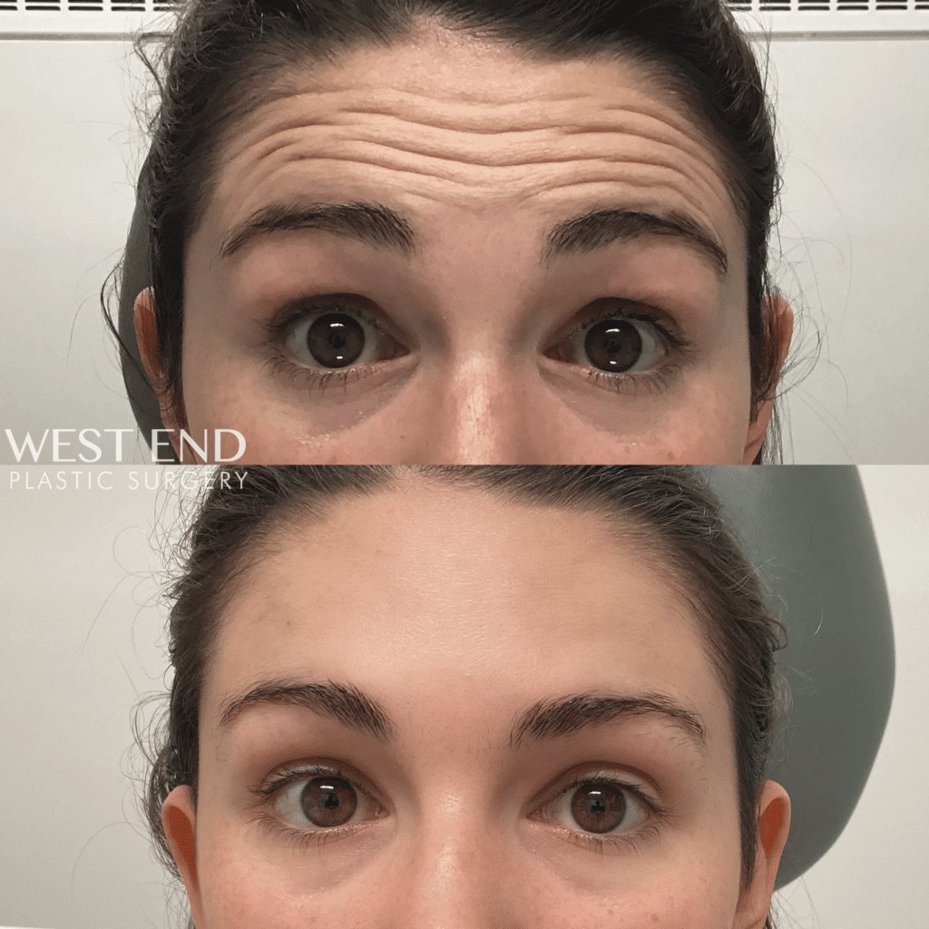 Before and After Image of BOTOX Injections Washington DC