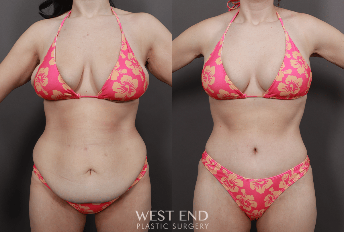 Tummy Tuck in Washington, D.C. | West End Plastic Surgery 2