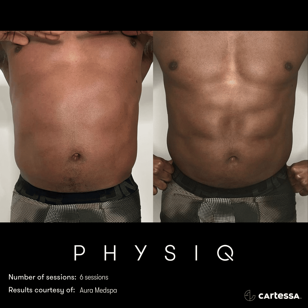 physiq body sculpting contouring before and after photo 1 west end plastic surgery