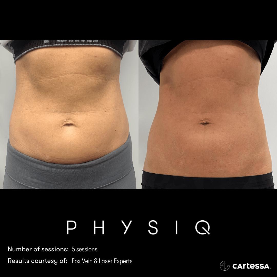 physiq body sculpting contouring before and after photo 2 west end plastic surgery