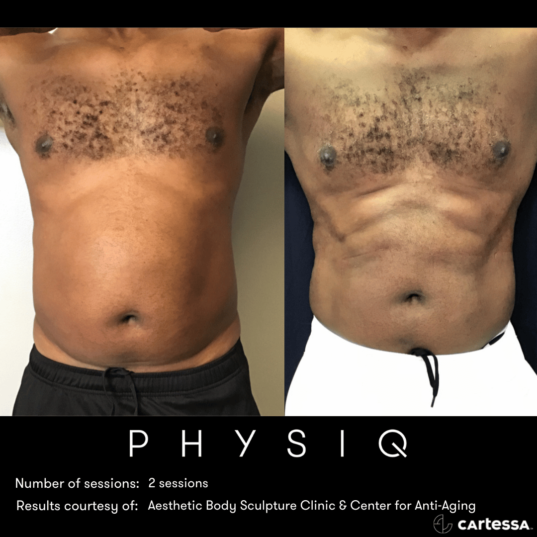physiq body sculpting contouring before and after photo 4 west end plastic surgery