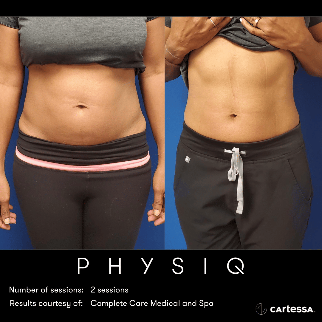 physiq body sculpting contouring before and after photo 3 west end plastic surgery