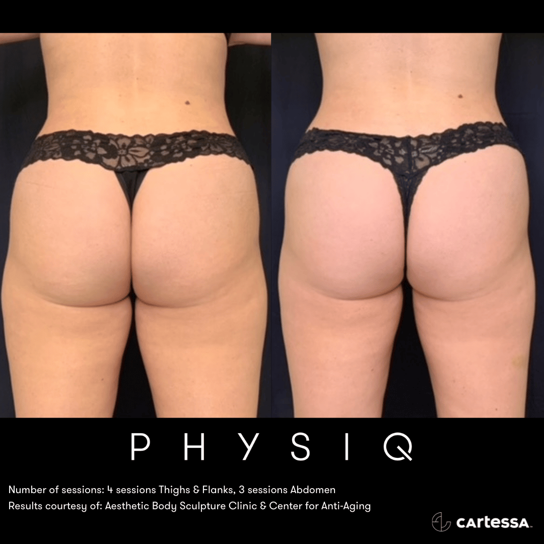 physiq body sculpting contouring before and after photo 5 west end plastic surgery