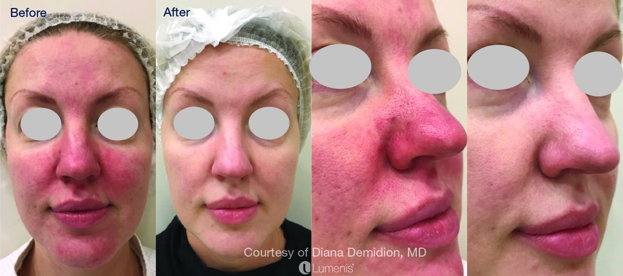 Before and After Image of Intense Pulsed Light Treatment Washington DC