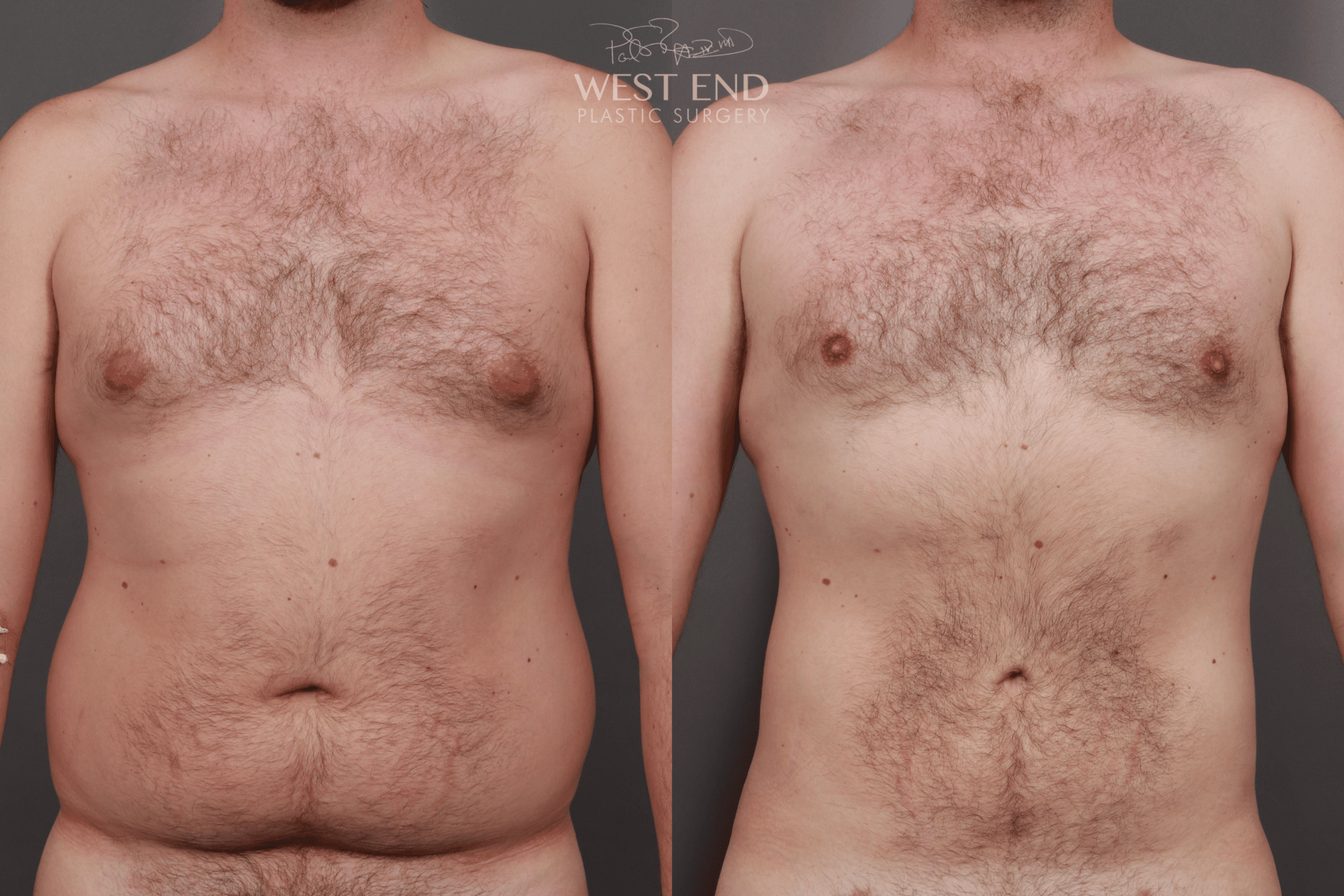 topless male patient before and after renuvion body sculpting, stomach flatter after procedure