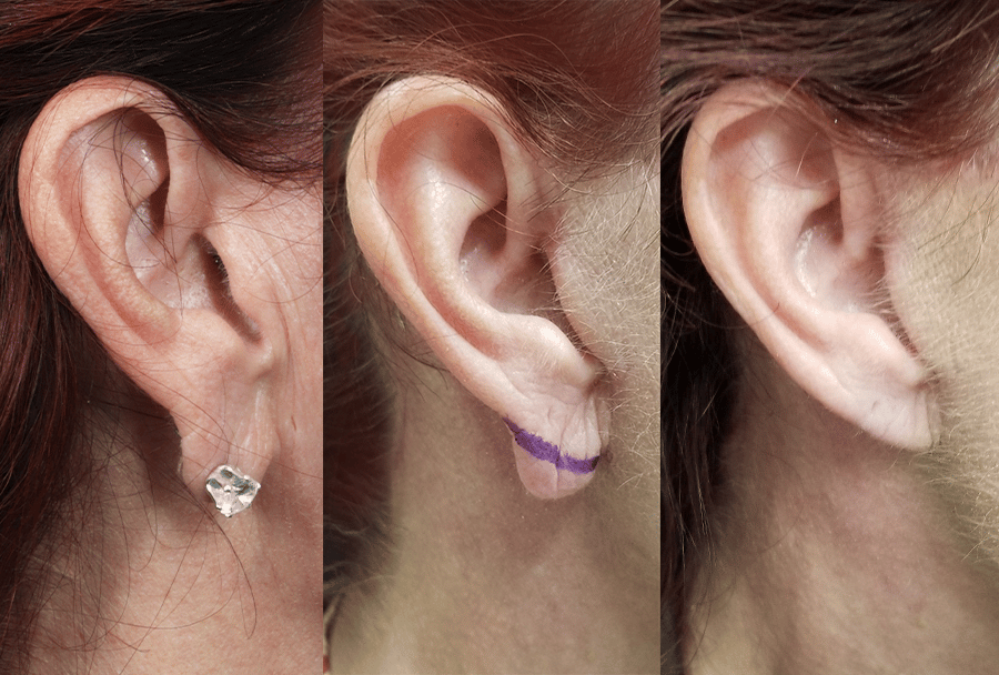 Earlobe Repair & Reduction - West End Plastic Surgery