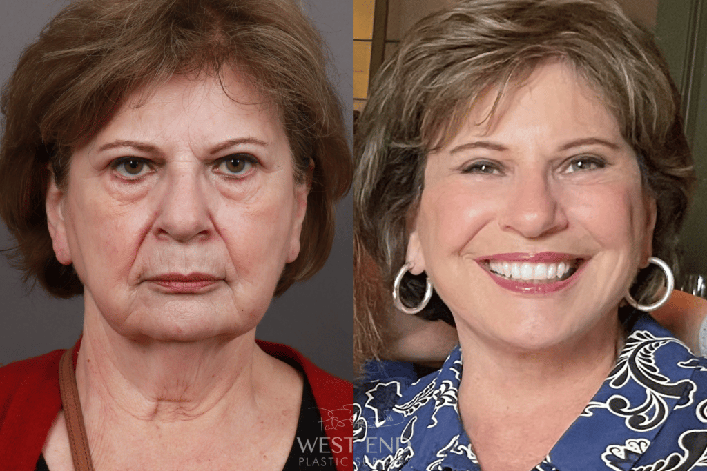 facelift surgery before and after west end plastic surgery exhibit a