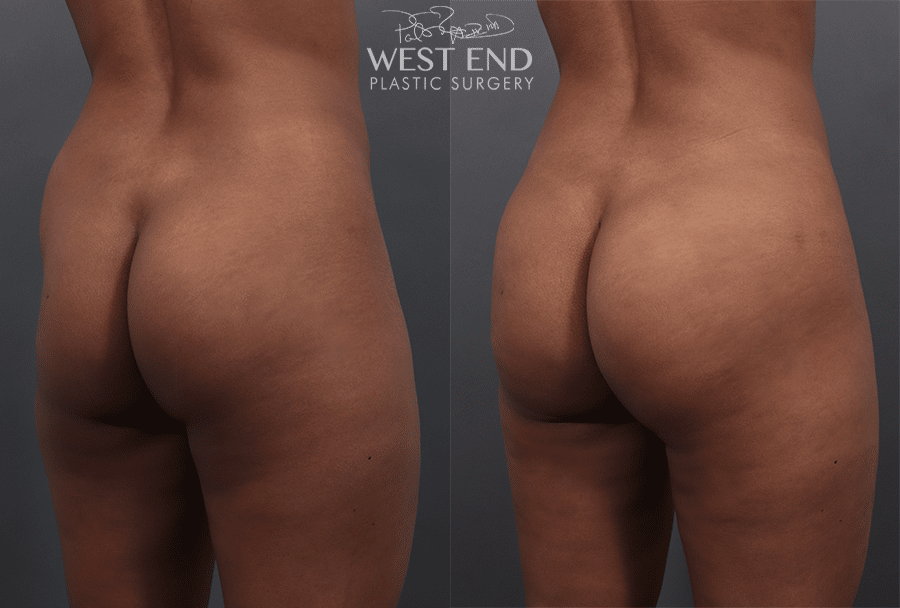 Brazilian Butt Lift Washington DC