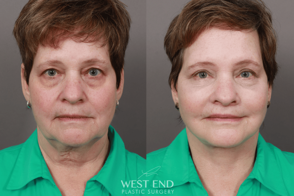 neck lift surgery before and after west end plastic surgery exhibit a