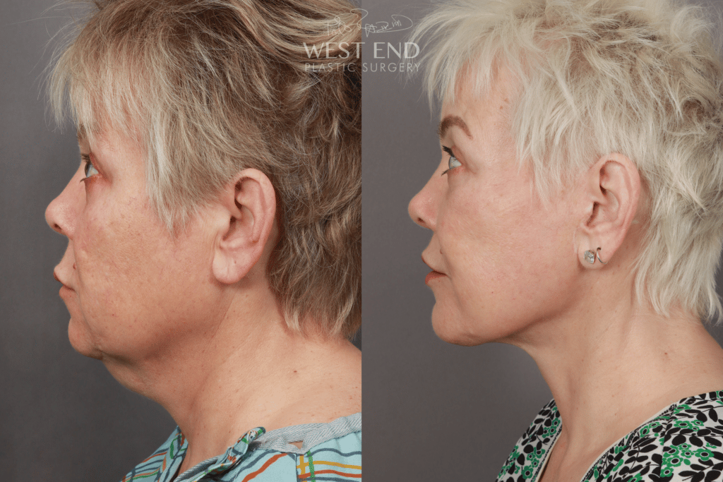 Neck shop plastic surgery