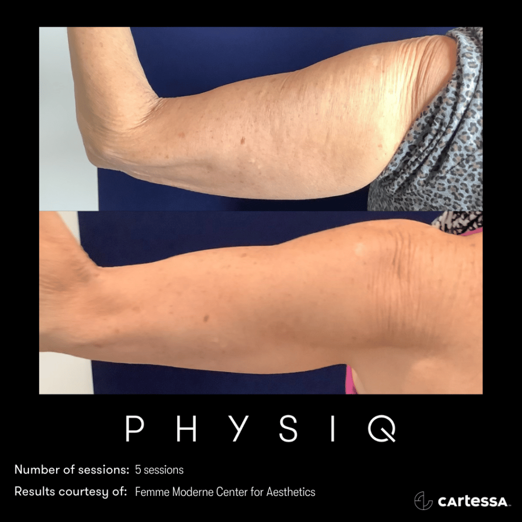 Two right arms of same woman, one on top of another, lower of which is thinner after 5 sessions of physiq body contouring treatment.