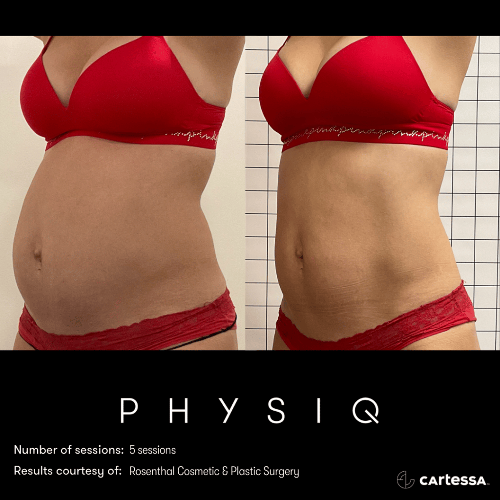 Woman's torso in red bikini before and after getting flatter stomach from physiq body contouring treatment