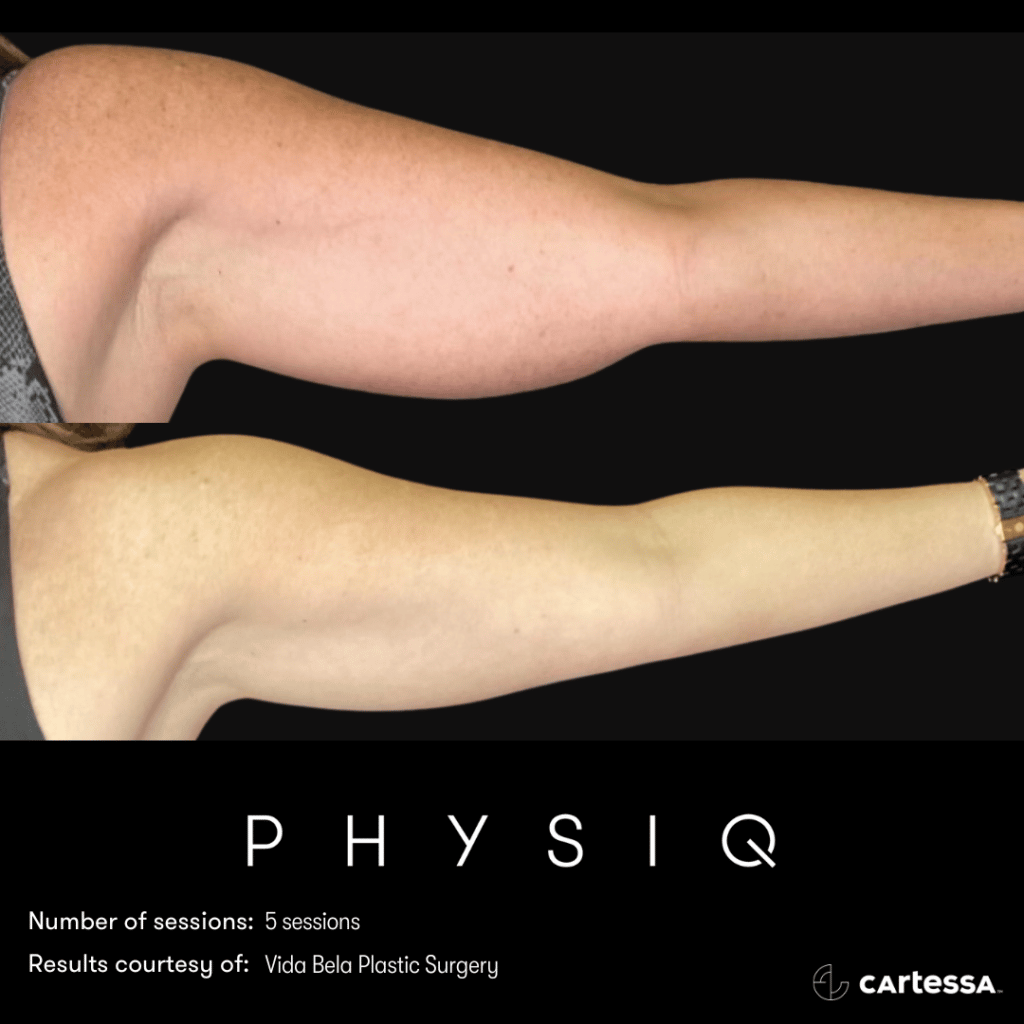 Two left arms, one on top of another, lower of which is thinner after 5 sessions of physiq body contouring treatment.