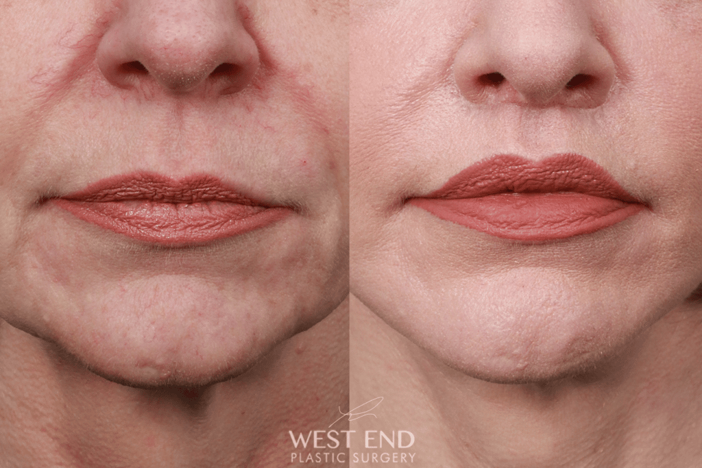 1 lip lift rectangle