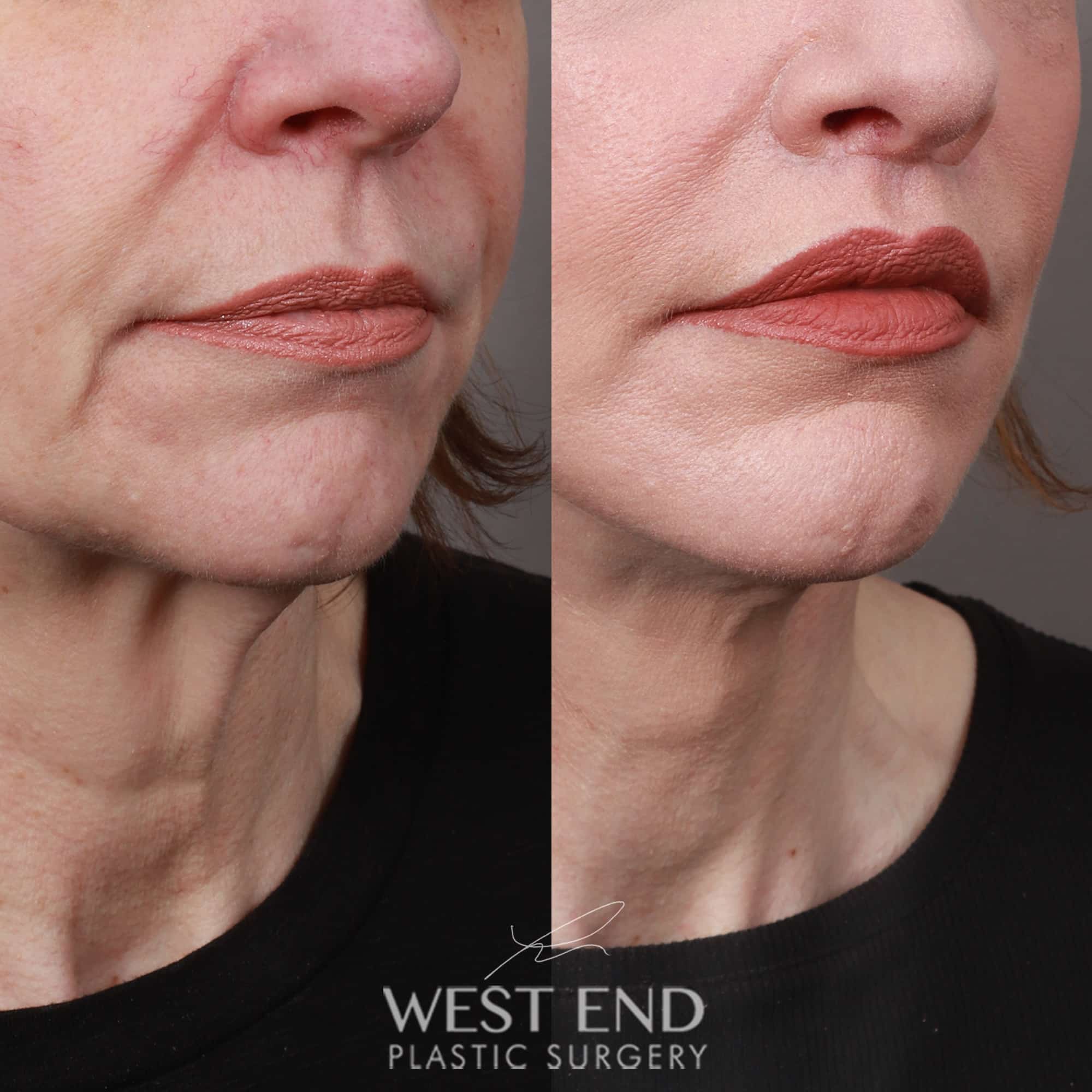 Lip Lift West End Plastic Surgery