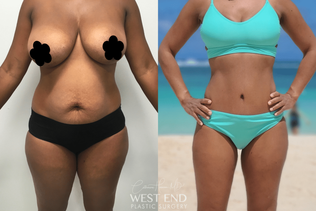 Trussler Plastic Surgery For Body