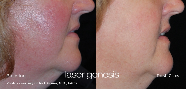 xeo LaserGenesis 3