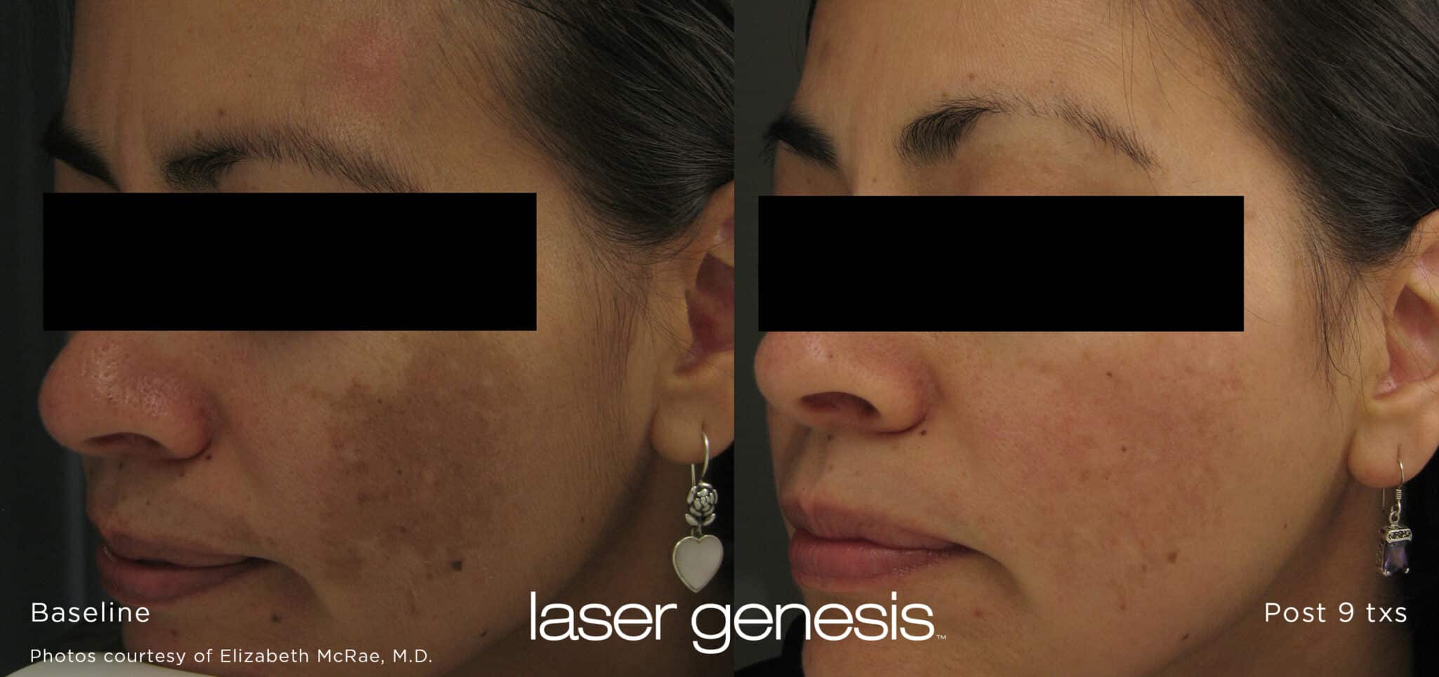xeo lasergenesis 1