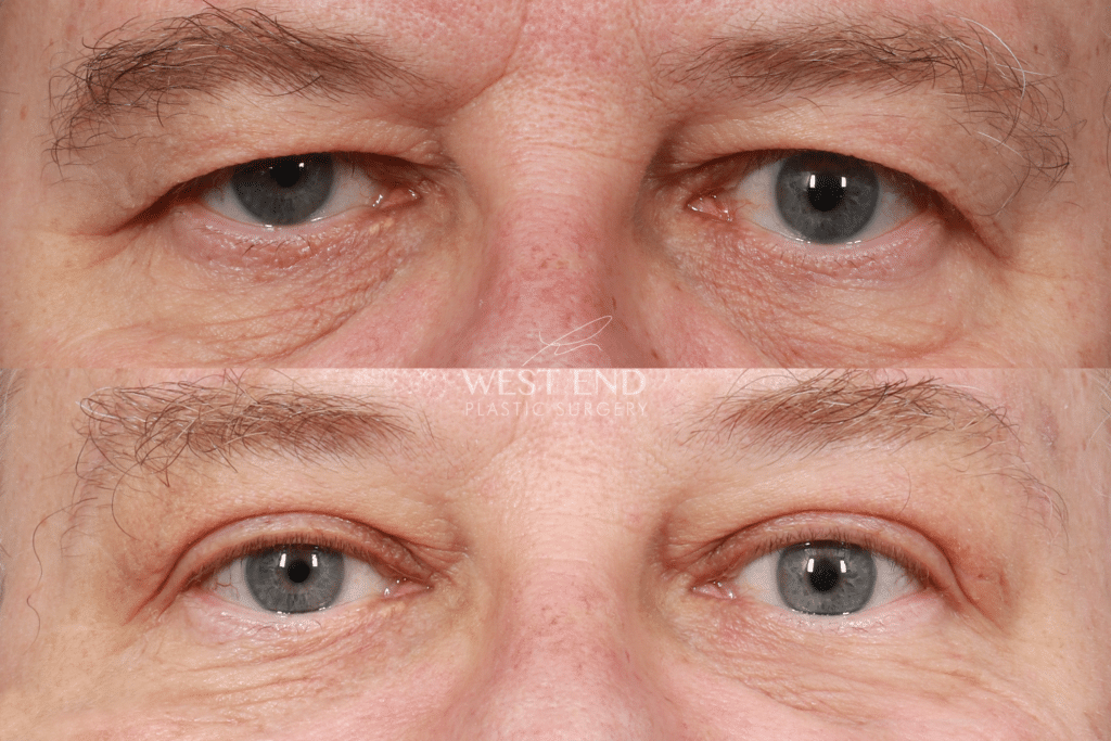 Lids By Design - the temporary non-surgical eyelid lift - Aesthetic Medical  Practitioner