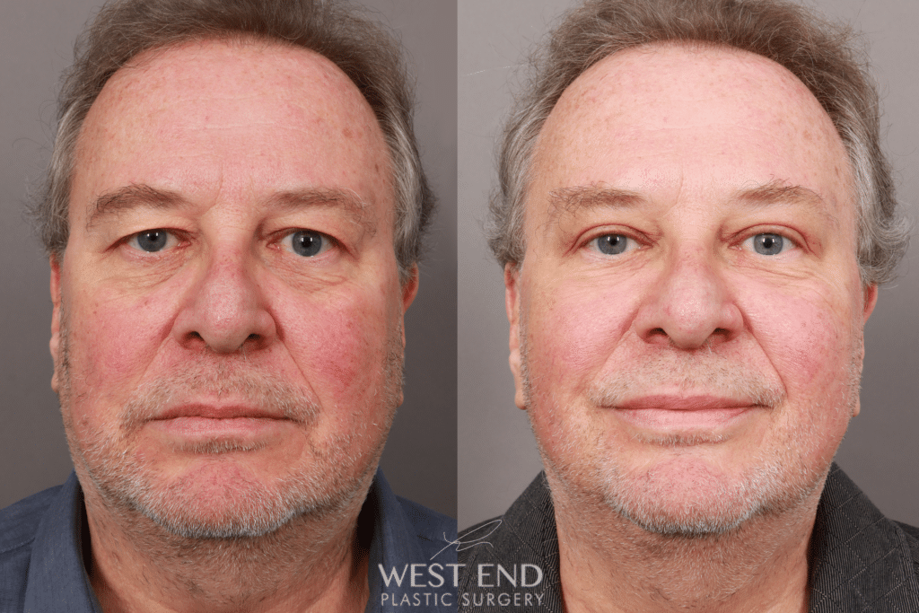 Brow Lift Surgery Washington DC