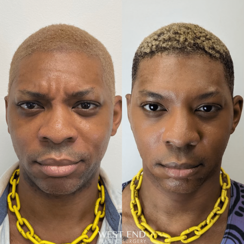 male patient before and after dysport treatment, frown line gone afterwards