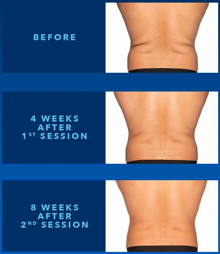 CoolSculpting for Bra & Back Fat - Benefits, Costs, Results