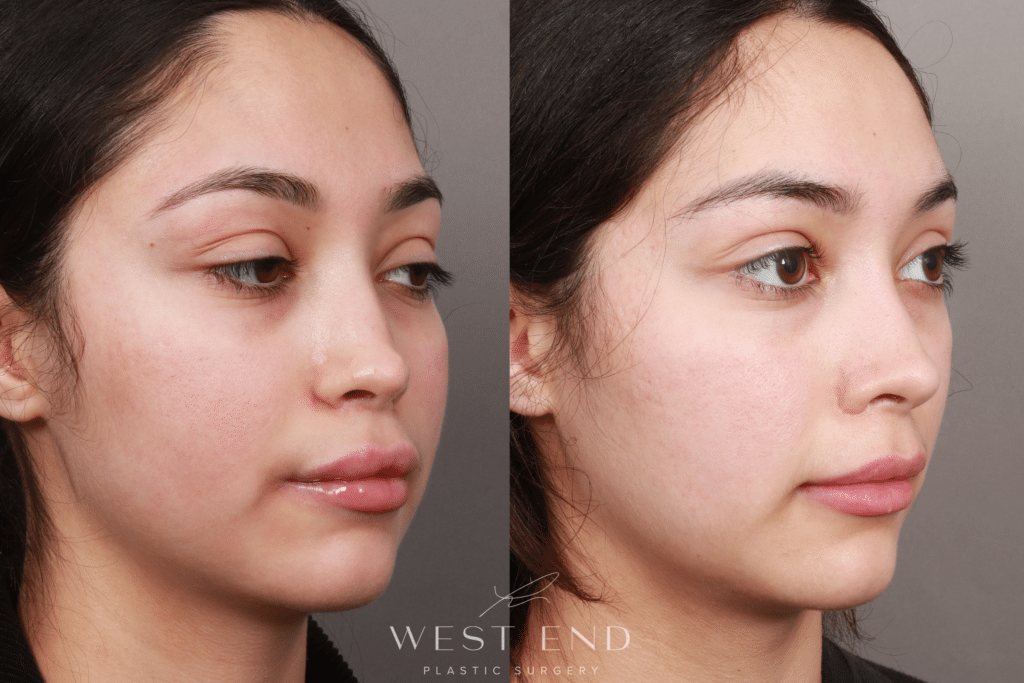 Blepharoplasty Washington DC