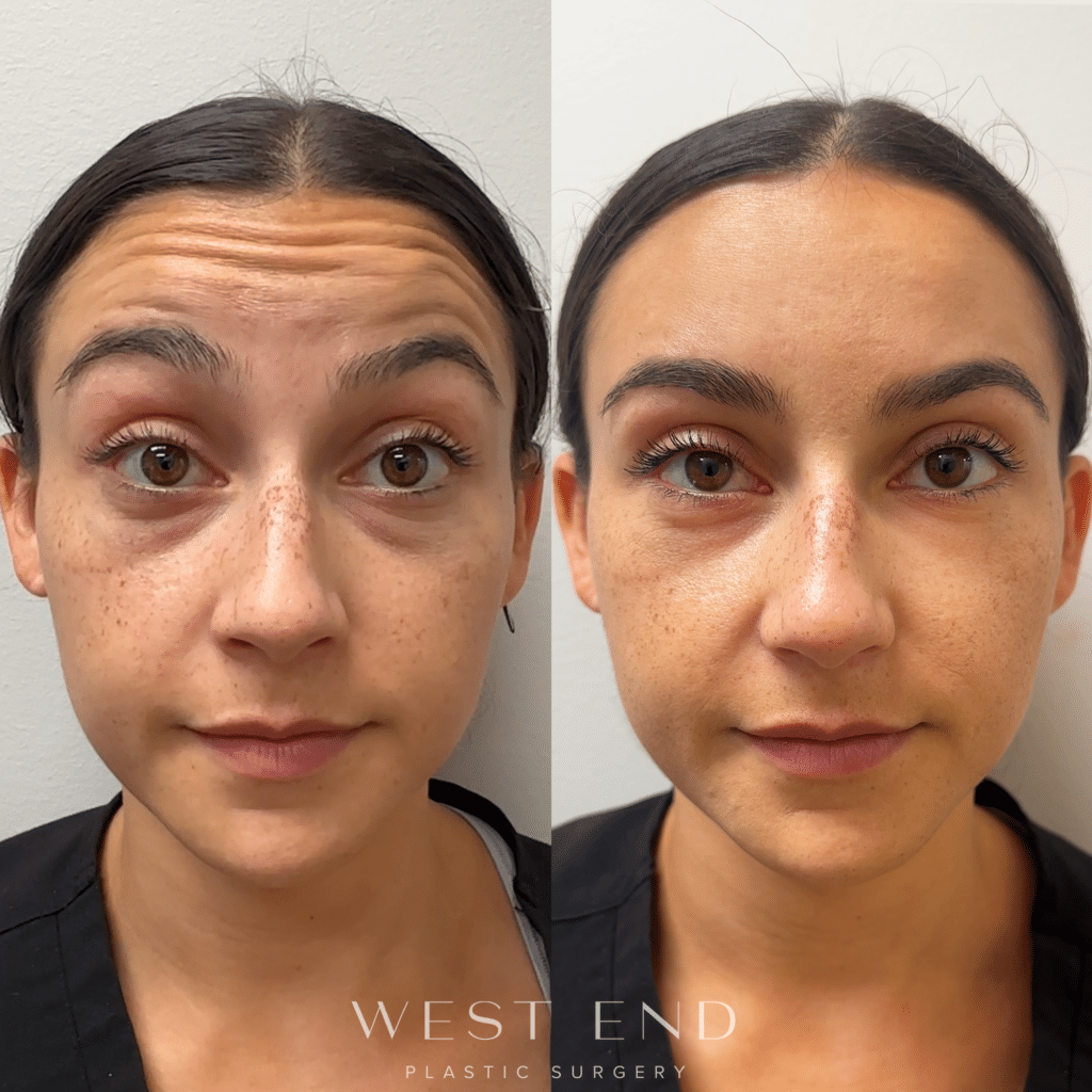 female patient’s face before and after dysport injections, wrinkles on forehead gone after treatment