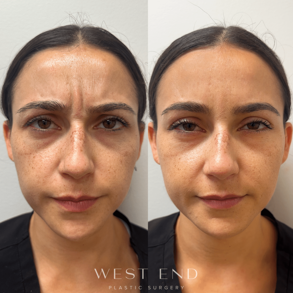 female patient’s face after dysport injections, frown lines gone after treatment