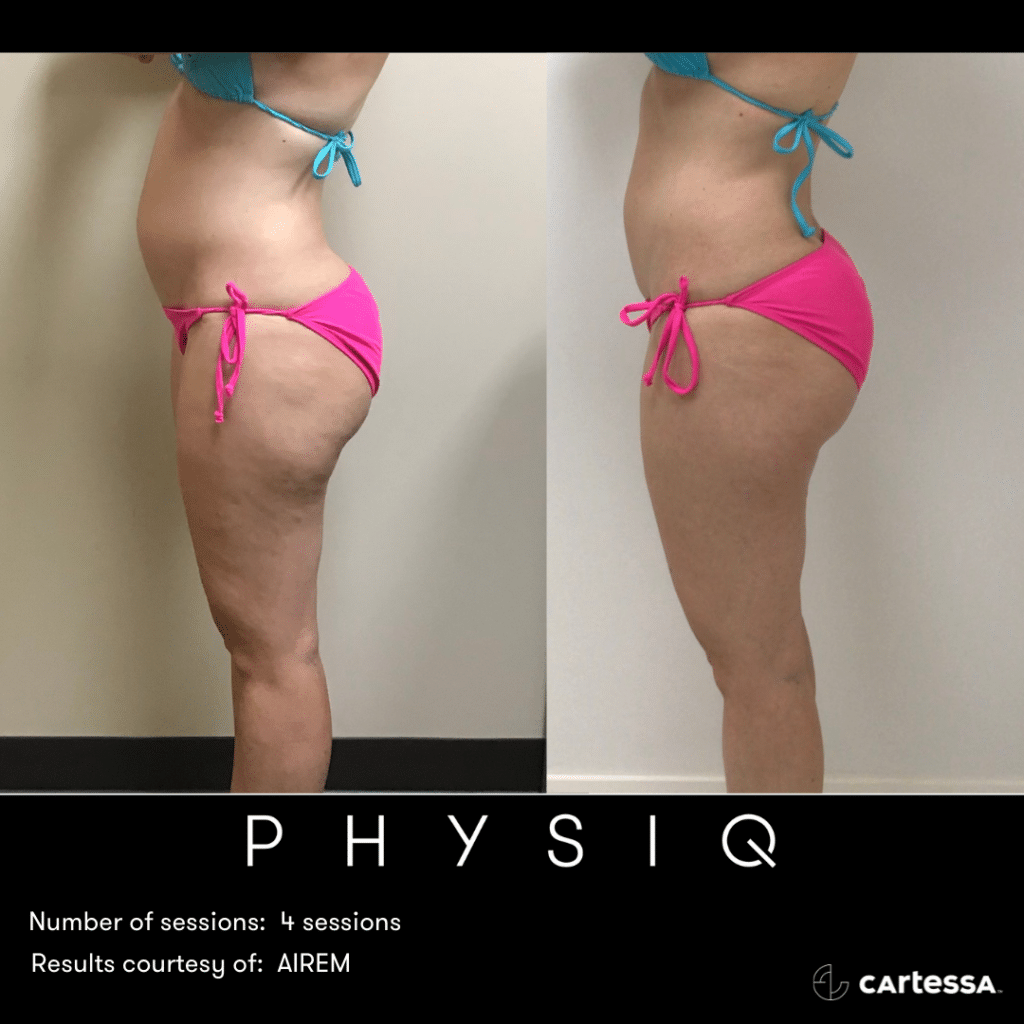 PHYSIQBAAbsThighsFlanks168796758923