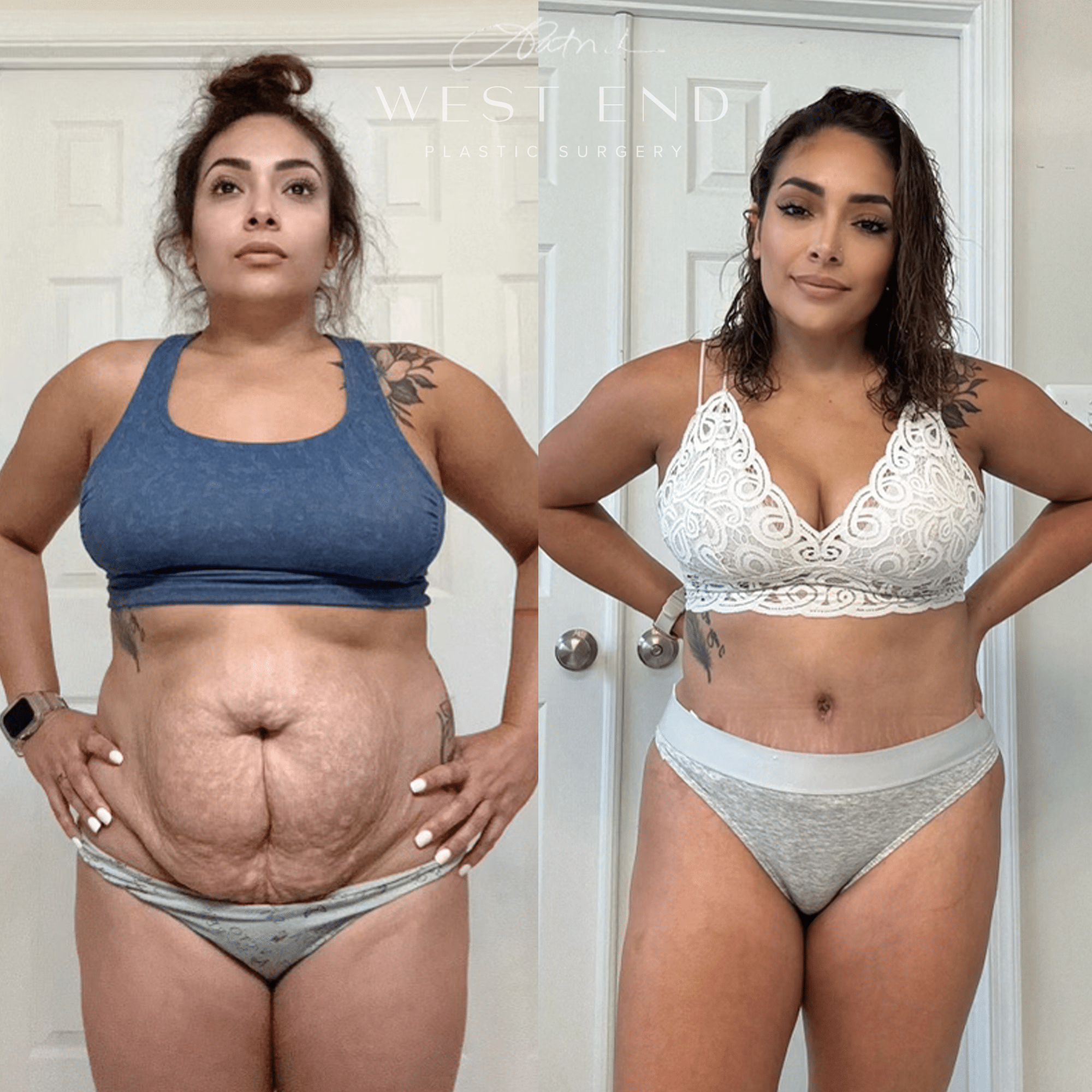 Abdominoplasty Results Washington DC