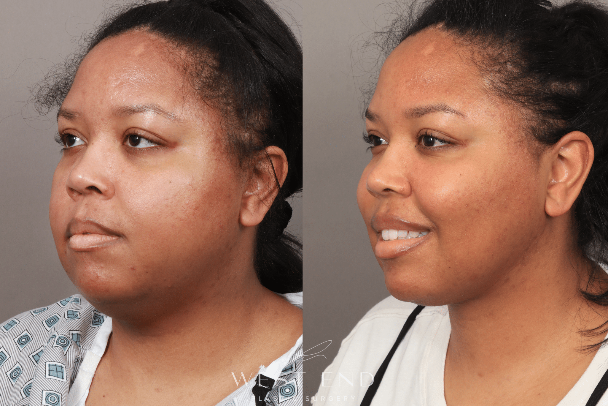 woman after buccal fat removal in Washington DC