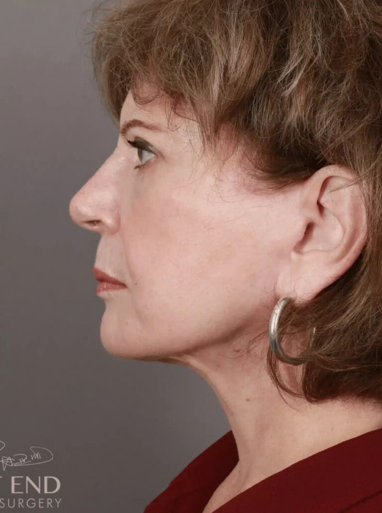 After Image: Deep Plane Facelift & Neck Lift, Brow Lift, Eyelid Lift, Fat Grafting, and CO2 Resurfacing (5 Months Post-Op) - left-side