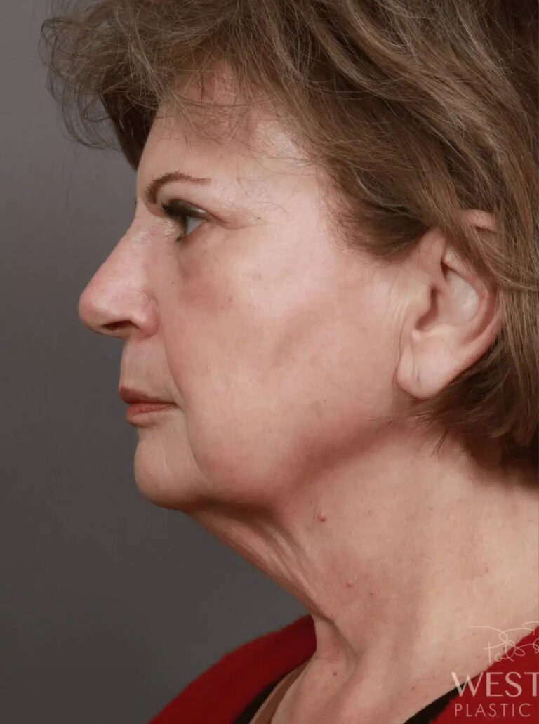 Before Image: Deep Plane Facelift & Neck Lift, Brow Lift, Eyelid Lift, Fat Grafting, and CO2 Resurfacing (5 Months Post-Op) - left-side
