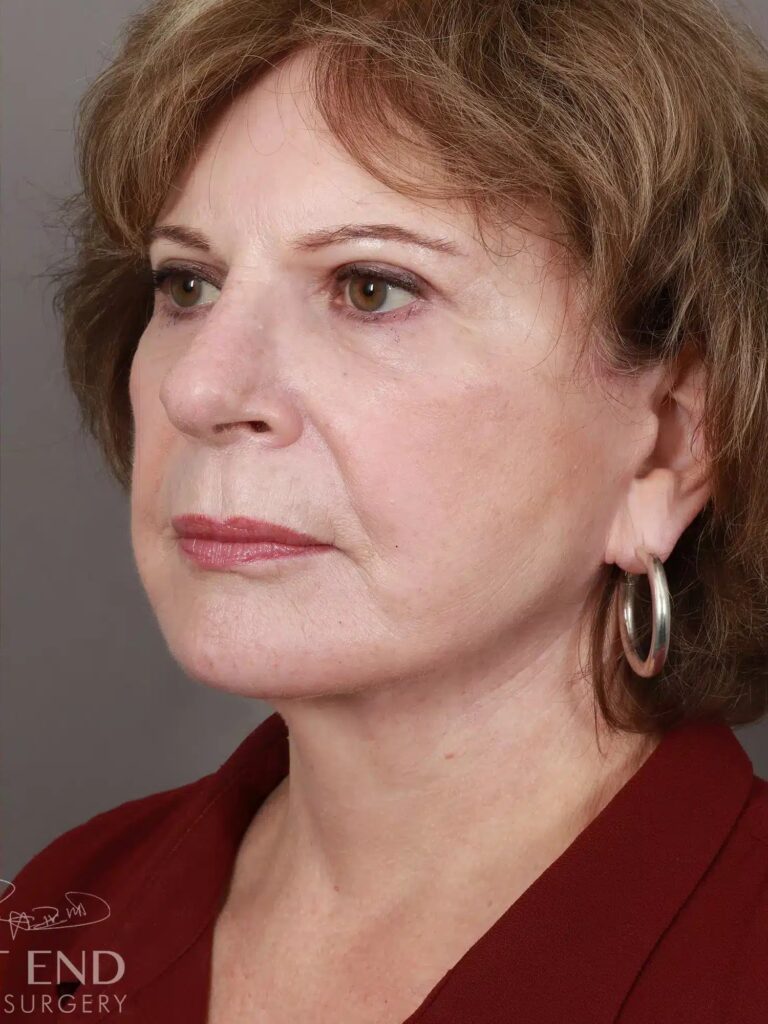 After Image: Deep Plane Facelift & Neck Lift, Brow Lift, Eyelid Lift, Fat Grafting, and CO2 Resurfacing (5 Months Post-Op) - left-front-oblique