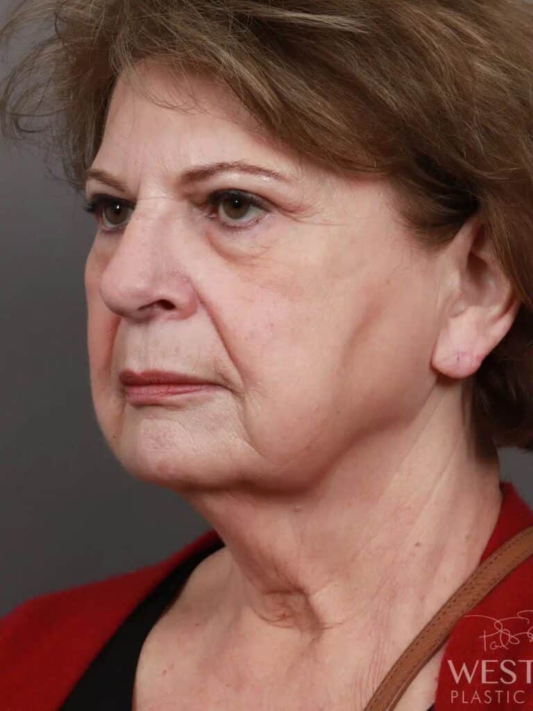 Before Image: Deep Plane Facelift & Neck Lift, Brow Lift, Eyelid Lift, Fat Grafting, and CO2 Resurfacing (5 Months Post-Op) - left-front-oblique