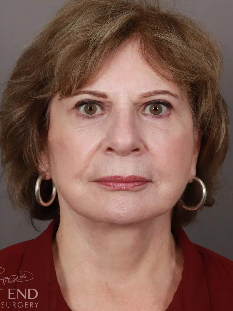 After Image: Deep Plane Facelift & Neck Lift, Brow Lift, Eyelid Lift, Fat Grafting, and CO2 Resurfacing (5 Months Post-Op) - front